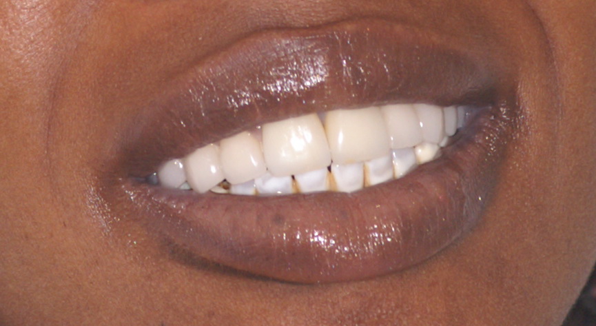 Facette dentaire Côte-d’Ivoire