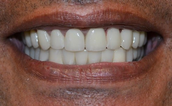 implant dentaire Côte-d’Ivoire