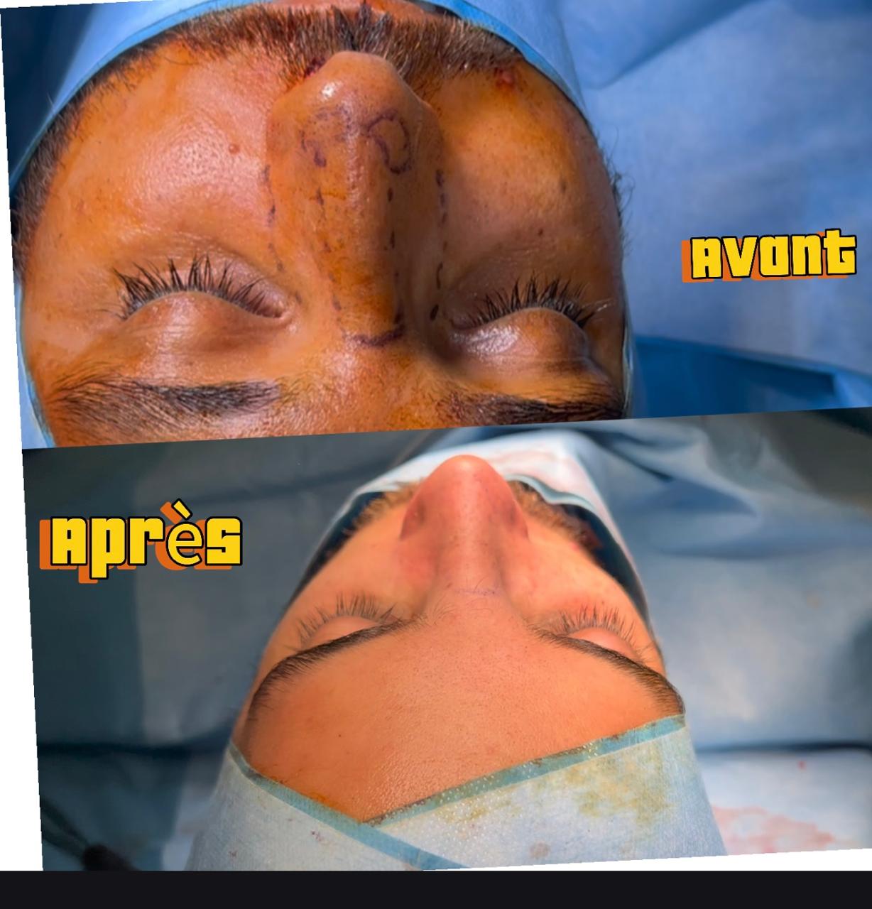 rhinoplastie nez avant apres 