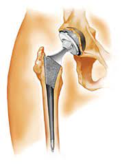 prothèse totale de la hanche